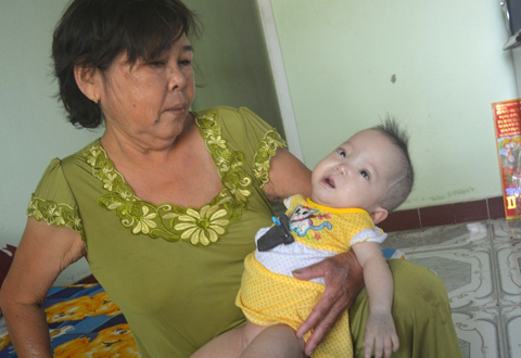 11-month-old baby girl with marble bone disease